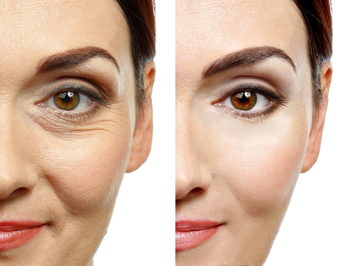 Woman face before and after cosmetic procedure
