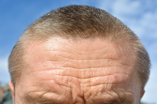 forehead wrinkles on man's forehead