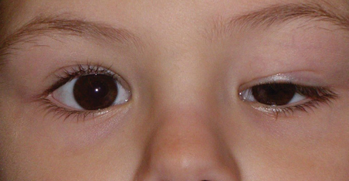 childhood eyelid ptosis